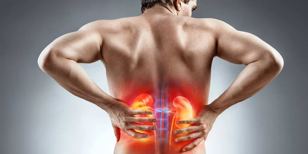 Symptoms of Kidney Stones