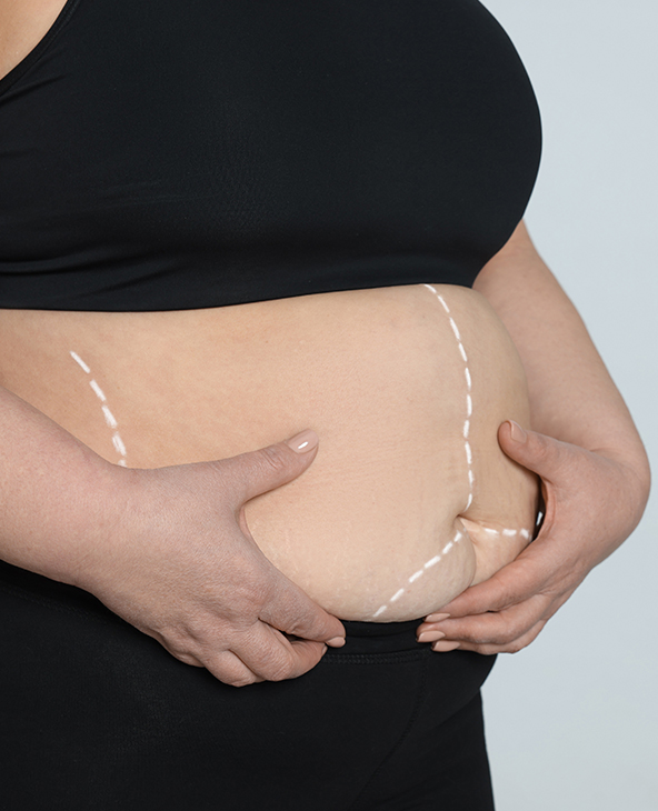 Bariatric Surgery