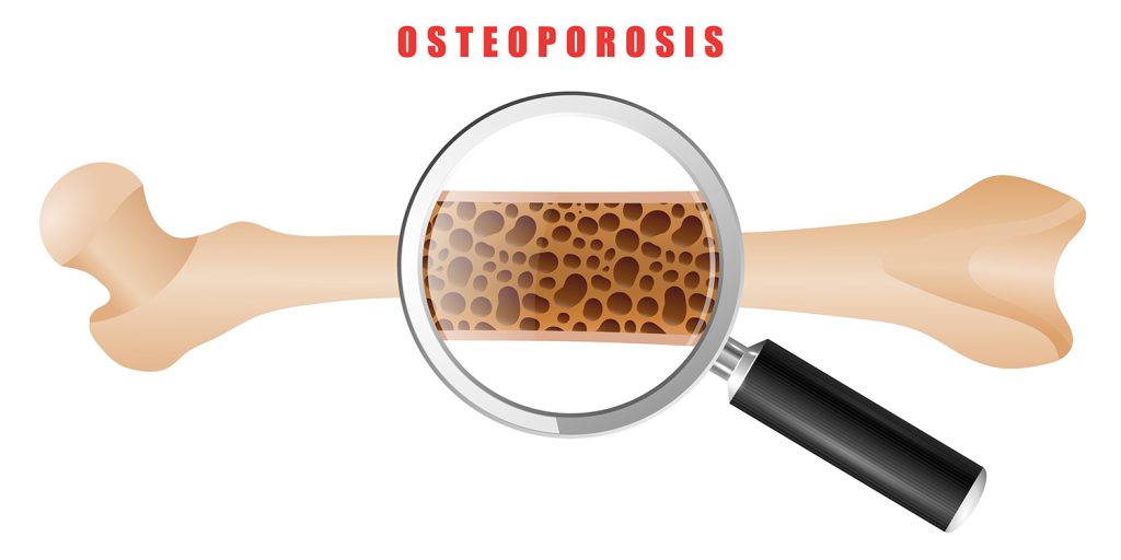 What is Osteoporosis