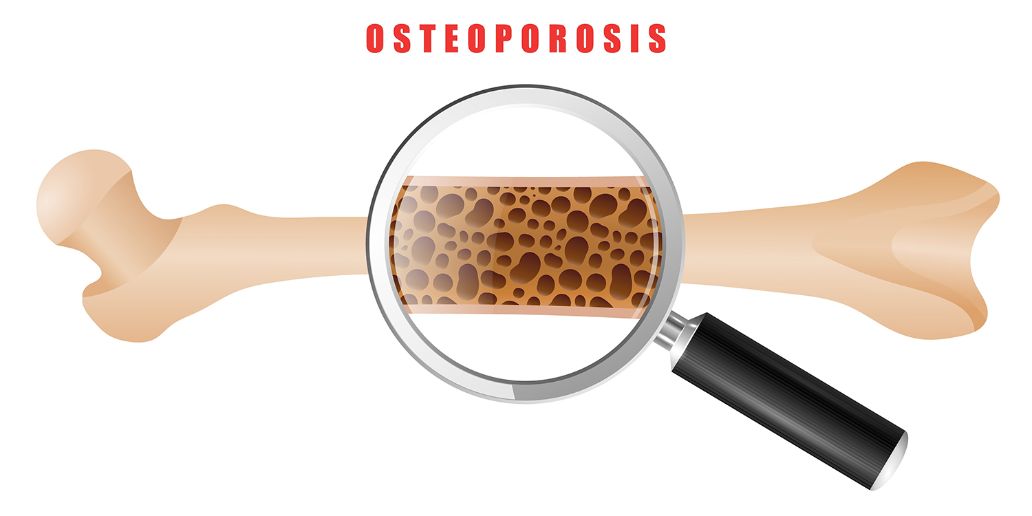 Osteoporosis: Early Warning Signs, Causes, and Treatment