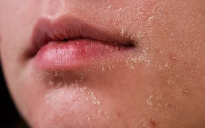 Dry Skin in Winter